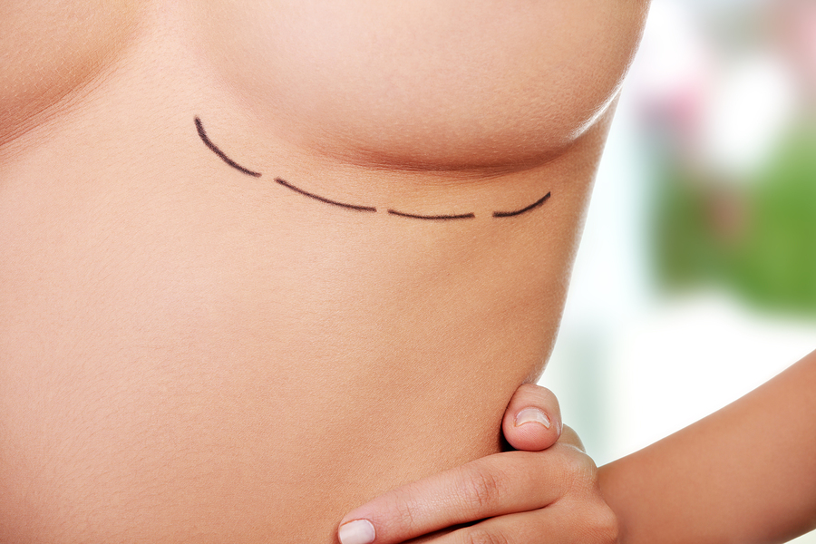 Woman breast marked out for cosmetic surgery.